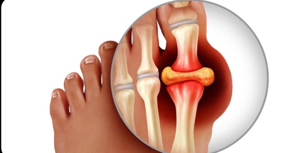 Can Moringa Help with Gout? What Research Says