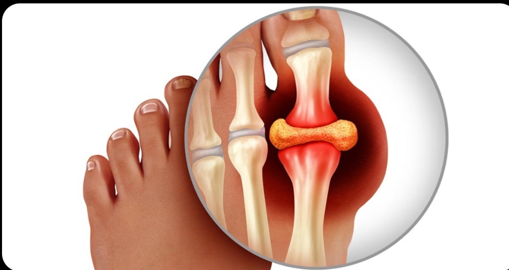 Can Moringa Help with Gout? What Research Says